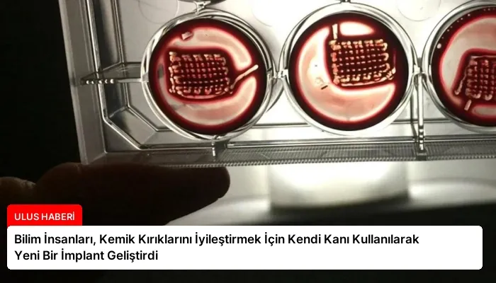 Bilim İnsanları, Kemik Kırıklarını İyileştirmek İçin Kendi Kanı Kullanılarak Yeni Bir İmplant Geliştirdi
